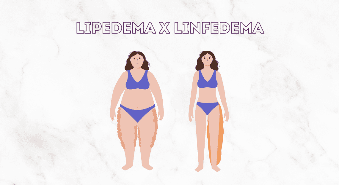 LIPEDEMA E LINFEDEMA: Por que é importante saber diferenciar?